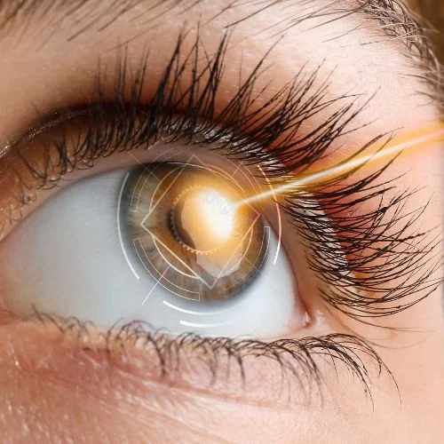 cirugia refractiva img1