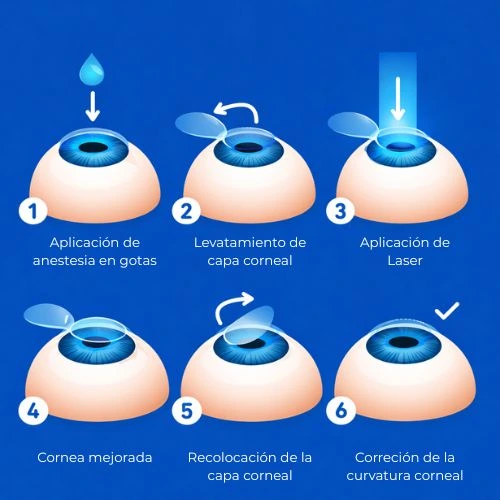 proceso cirugia refractiva