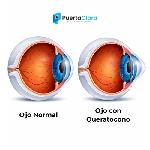 queratocono img1b