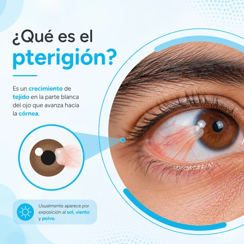que es pterigión pc