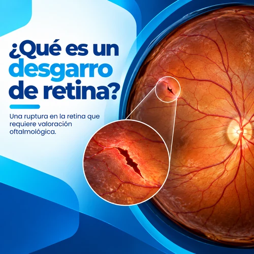 que es desgarro de retina pc (2)